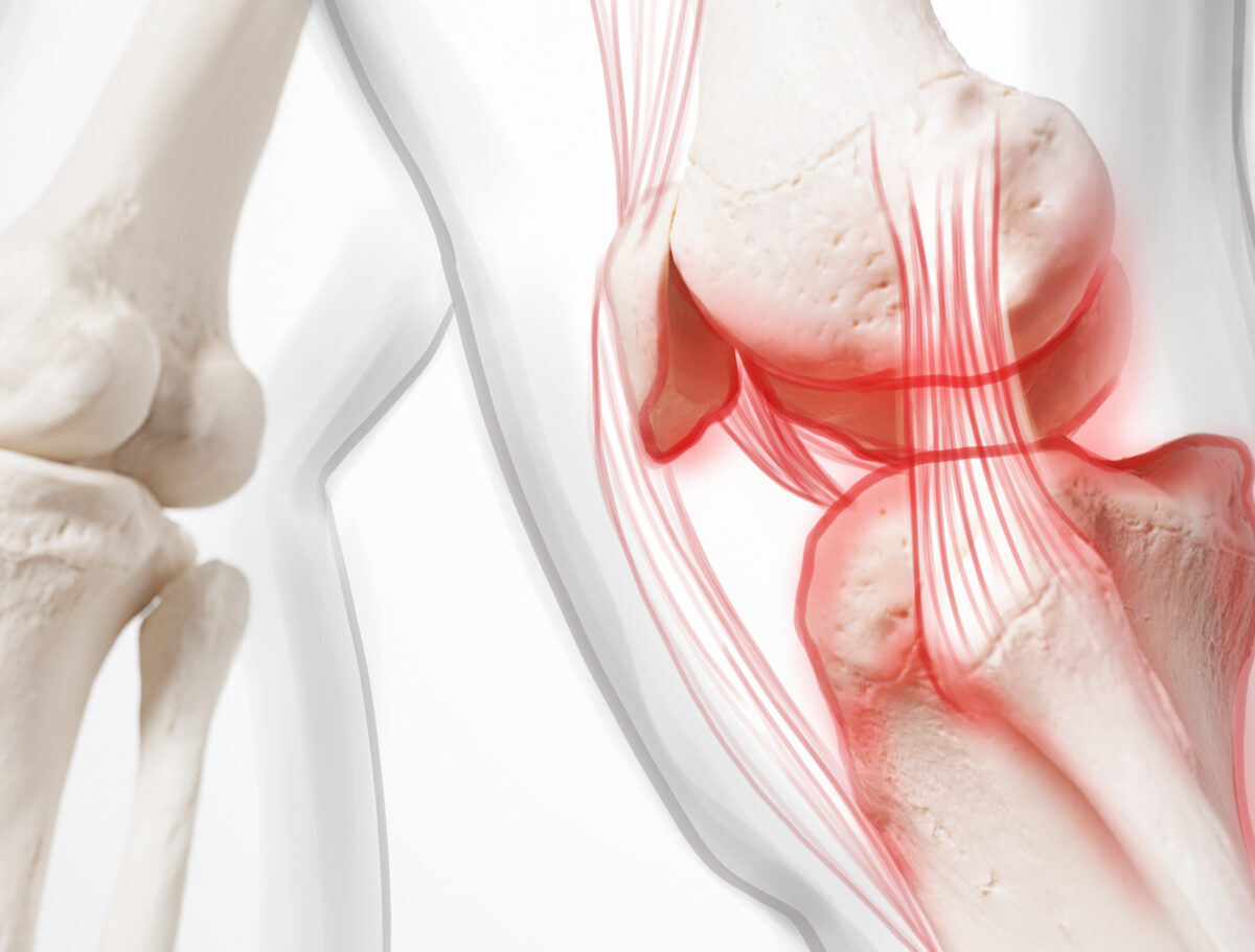 Kinematic Knee Arthroplasty